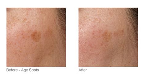 tria 4x before and after|how long does tria laser last.